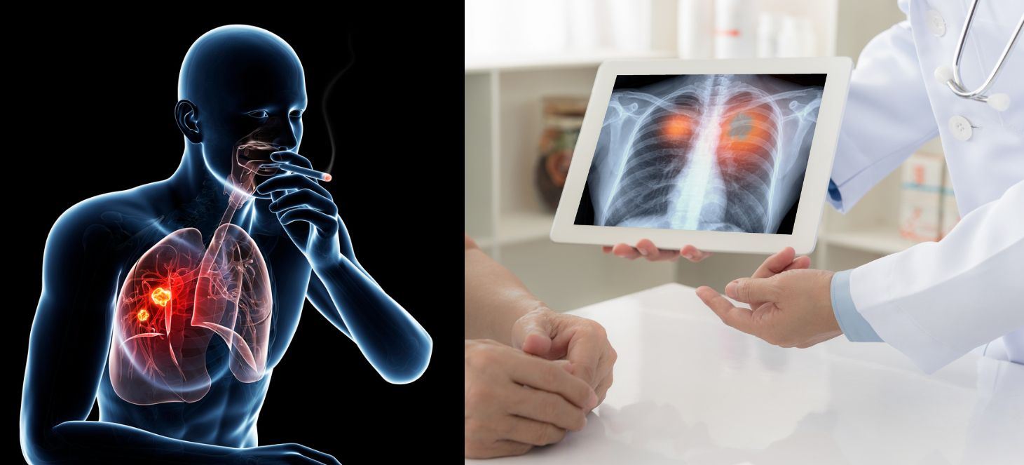 Riesgo de cancer de pulmón en no fumadores - Dr. Eli Zavaleta